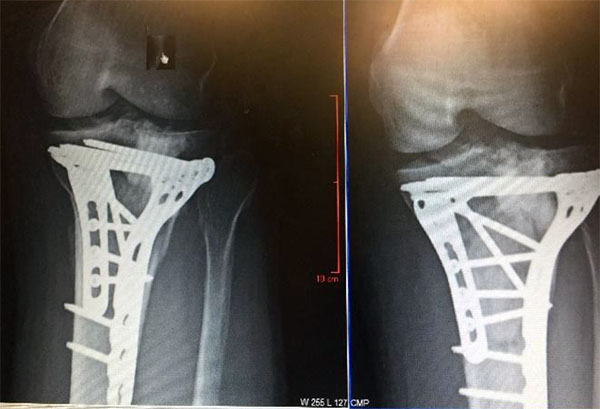 broken tibia x rays