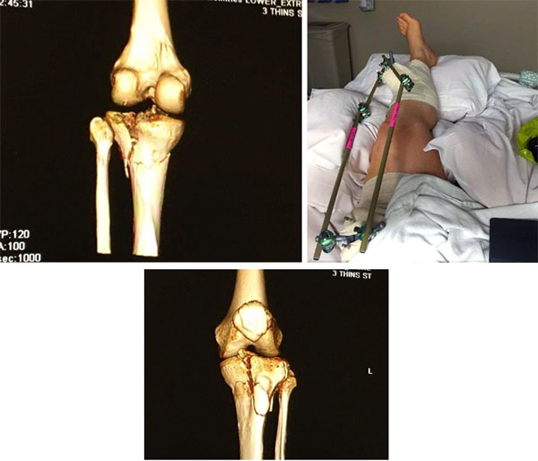 shattered tibia pictures